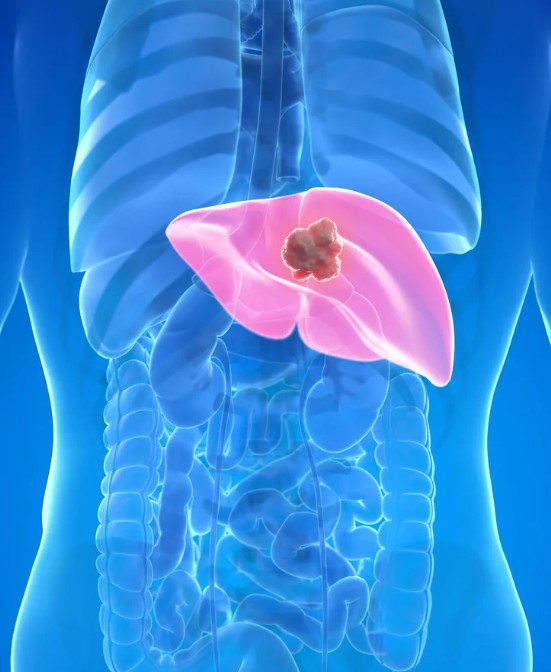 Liver Cancer - Andy Gaya Oncologist