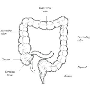 Bowel Cancer - Andrew Gaya